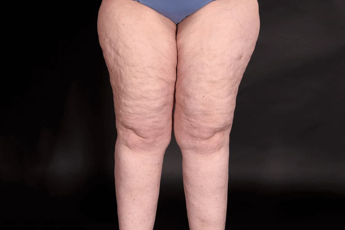 Lipödem erkennen: Die Rolle der Hormone bei der Entstehung